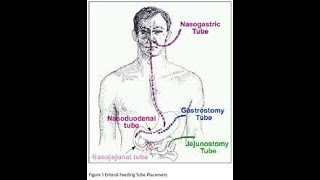 Jejunostomy Feeding Tube [upl. by Leagiba]