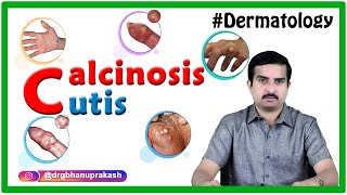 Calcinosis cutis  Dermatology clinicalessentials [upl. by Yeliw]