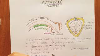 Hypospadias clinical features [upl. by Shana600]