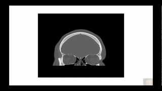 Bony orbital and skull base anatomy pathology in Coronal Plane [upl. by Gardener448]