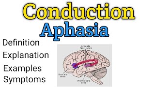 Conduction aphasia  What is Conduction aphasia  What is aphasia  Aphasia  Arcuate fasciculus [upl. by Arv485]