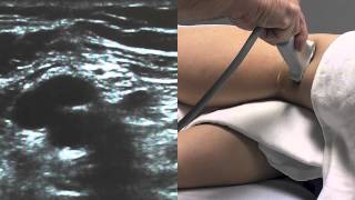 Ultrasound Guided Popliteal Sciatic Nerve Block  SSRAUSAcom [upl. by Hays25]