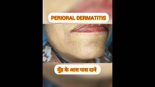 PERIORAL DERMATITIS मुँह के आसपास दाने  और उपचार acne allergy skincare shorts shortsfeed [upl. by Narda576]