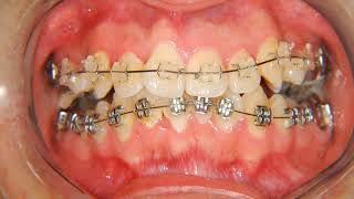 Brackets AnTeS y DeSpUeS APIÑAMIENTO DENTARIO SEVERO 😎🦷 [upl. by Nehttam788]