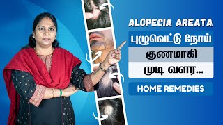 Alopecia Areata Treatment at Home in Tamil  தலை முடியில் புழு வெட்டு  பூச்சி வெட்டு தீர்வுகள் [upl. by Prady]