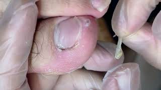 So much dirt under nail and totally clean itNail healthy [upl. by Reddy]