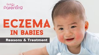 Baby Eczema  Causes Signs and Treatment [upl. by Rramahs]