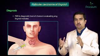 Thyroid neoplasms part 2  Follicular carcinoma of thyroid   Endocrine pathology [upl. by Marja296]