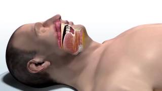 Inspire Therapy for Obstructive Sleep Apnea [upl. by Aicat]