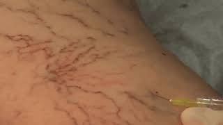 Visual Sclerotherapy on Spider Veins [upl. by Ramled]