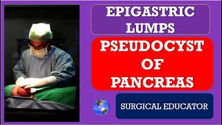 PSEUDOCYST OF PANCREAS  How to DIAGNOSE amp TREAT Epigastric Lumps Abdominal Lumps [upl. by Chalmers]