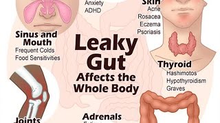 6 Steps to Heal Leaky Gut and Autoimmune Disease Naturally  Health Vlogger [upl. by Sheilah895]