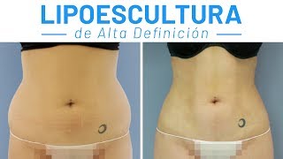 Lipoescultura Váser de Marichu del Amo DIRECTO  Lipotransferencia a Glúteos [upl. by Iruy]