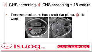 ISUOG guidelines on the sonographic examination of the fetal CNS part 1 [upl. by Zeb]