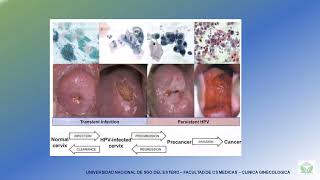 PREVENCION DE CANCER CUELLO UTERINO MODULO PATOGENIA [upl. by Joo]