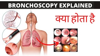 bronchoscopy Explained in Hindi क्या होता है [upl. by Bergeron]