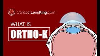 What is Orthokeratology or OrthoK [upl. by Lasonde]