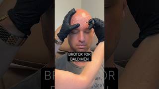 BOTOX FOR BALD MEN [upl. by Ahcarb]