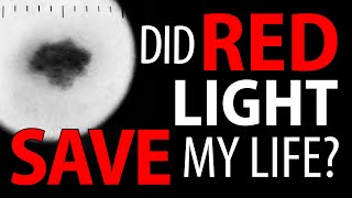 Red Light Therapy  My Skin Cancer Part 2 [upl. by Balfour342]