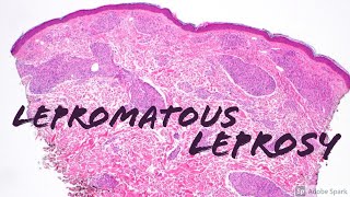 Lepromatous Leprosy 5Minute Pathology Pearls Dermatology Dermatopathology [upl. by Aseela538]