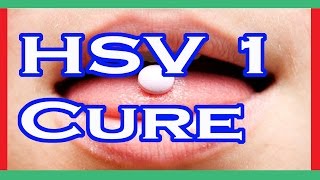 HSV 1 Cure  Herpes Simplex Virus 1 Cure [upl. by Warfold321]