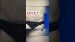 腹部整形重修手術，術後疤痕4年後追蹤 [upl. by Arno141]