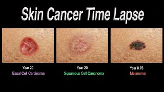 Skin Cancer Time Lapse Basal Cell Carcinoma Squamous Cell Carcinoma Melanoma [upl. by Seedman]