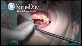 Two visit Immediate implant maxillary rehabilitation at Sameday Dental Implants Clinic [upl. by Rozalin]