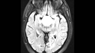 Adamantinomatous Craniopharyngioma [upl. by Akenat189]