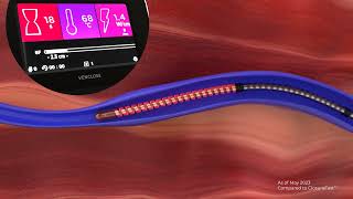 Venclose™ RF Ablation Catheter [upl. by Bowers]