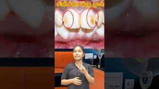 சேலம் fluorosis  bleaching பற்களுக்கு செய்யலாமாshorts [upl. by Lavoie]