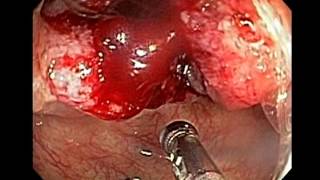 Endoscopy of Colon Cancer Cecum [upl. by Enylekcaj]