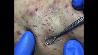 More Craters  More Blackheads WATCH THESE PIMPLES Originial ASMR [upl. by Shina831]