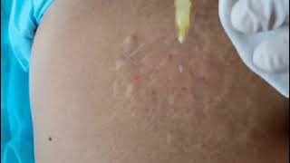 Stretch marks injection video of Reborn PLLA dermal filler [upl. by Ailaht]