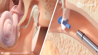 Ear Tube Insertion Procedure Tympanostomy Hummingbird inoffice Tympanostomy System [upl. by Eidnam569]