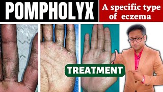 Dyshidrotic eczema  Pompholyx  Treatment  Hindi [upl. by Konstantine]