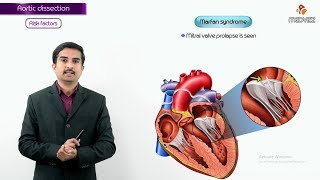 Aortic dissection  Risk factors Signs and Symptoms Diagnosis Treatment  Part 2 [upl. by Johppah]