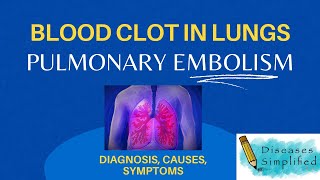 Pulmonary Embolism Blood Clot In Lungs Diagnosis Symptoms amp Causes [upl. by Okir]