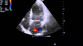 clear view of ischemic dilated cardiomyopathy with MR [upl. by Darnell]