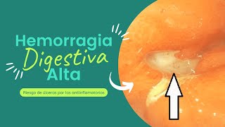 Riesgos de los Antiinflamatorios Úlceras y Hemorragia Digestiva Alta [upl. by Irama]