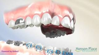 How a Fixed Bite Plate Works [upl. by Astri]