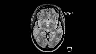 White matter disease associated with migraine headaches [upl. by Samara]