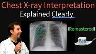 Pneumothorax Rapid Review of Chest Xrays [upl. by Ennagem886]