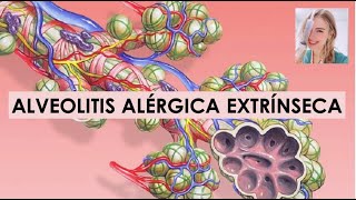 LA ALVEOLITIS ALÉRGICA EXTRÍNSECAHÚMEDA FISIOPATOLOGÍA SÍNTOMAS Y TRATAMIENTO [upl. by Rayner]