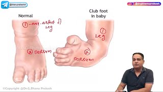 Club Foot  Congenital talipes equinovarus Hindi  Orthopedic Lectures [upl. by Sanderson161]