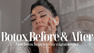 Botox Injection Before and After amp How It Helps my Migraine  By Sarv [upl. by Barby721]