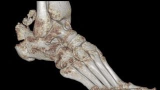 Ct Case Of Calcaneal tuberosity avulsion fracture l Ct Ankle joint [upl. by Curley]