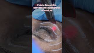 Under Eye Wrinkles Reduction with Fotona SmoothEye [upl. by Nadual]