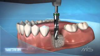 Procedimiento de colocación de implante dental MIS El Salvador [upl. by Ragas542]