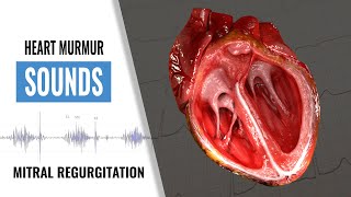 Mitral Regurgitation Heart Sound  Heart Sounds  Heart Murmur  Christina NP [upl. by Dlanigger132]